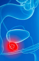 Prostatitis