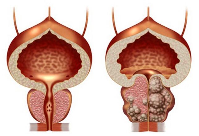 healthy prostate and prostate adenoma