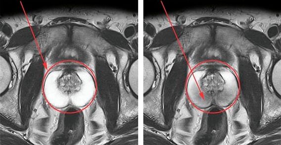 Normal prostate (left) and inflamed prostate with prostatitis (right)